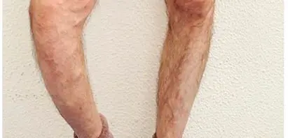 Varicoză picioare marznut - Varicoză în recomandările mici pelvis