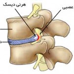 دیسک کمر