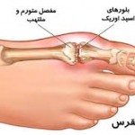 بیماری نقرس