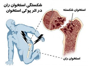 پوکی استخوان از وب سایت دکتر نقی حسینعلی زنجانی