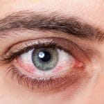 چشم و بیماری های روماتیمسی